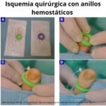 anillos isquemicos hemostaticos