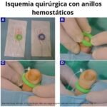 Anillos hemostáticos para isquemia quirúrgica - Imagen 4