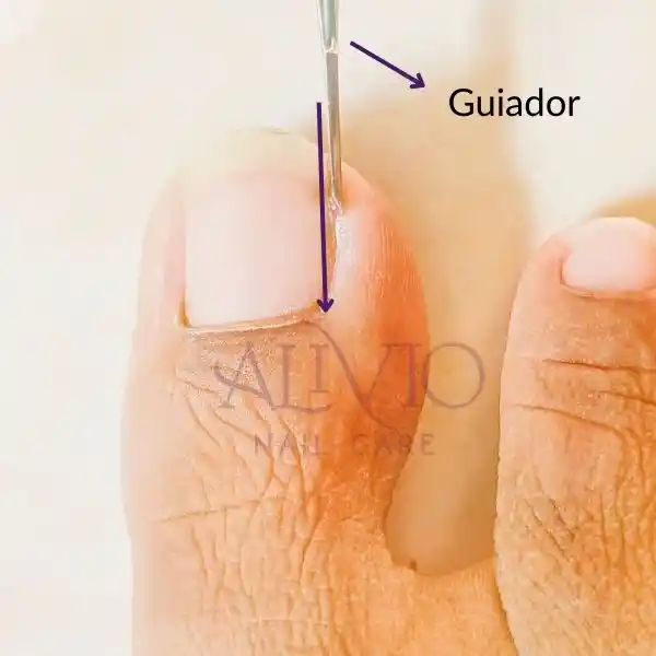 Todo lo que debes saber sobre el guiador para tratar uñas encarnadas